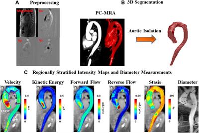 Hemodynamic Assessment in Bicuspid Aortic Valve Disease and Aortic Dilation: New Insights From Voxel-By-Voxel Analysis of Reverse Flow, Stasis, and Energetics